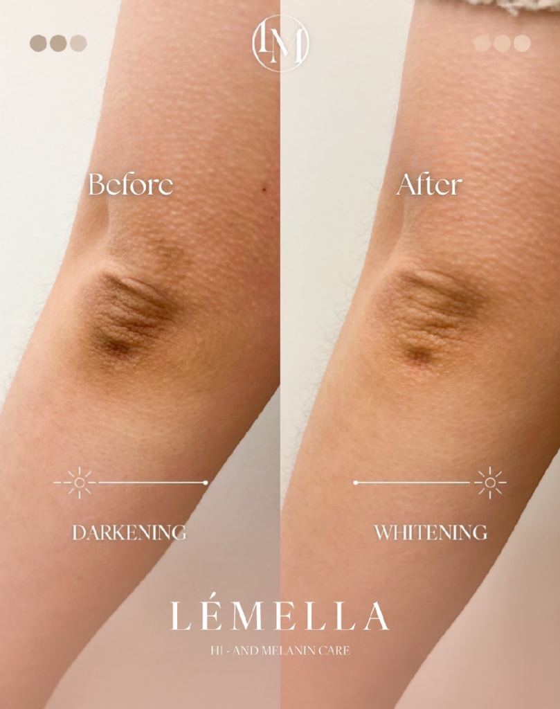 色素沈着について