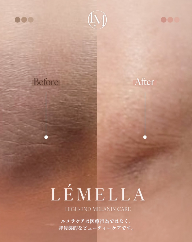 多くの方が抱える黒ずみにアプローチ